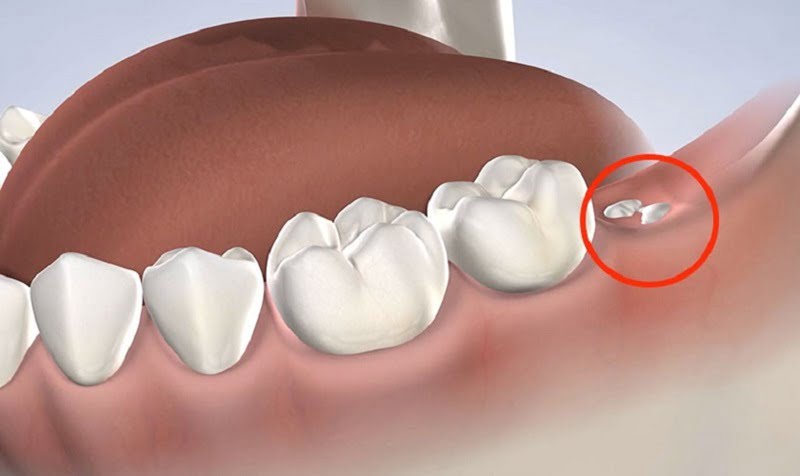 Mơ thấy rụng răng khôn hãy thử vận may với số 23 Mơ thấy rụng răng khôn hãy thử vận may với số 23
